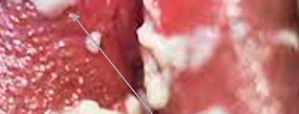 yeast infection treatment in Zambia